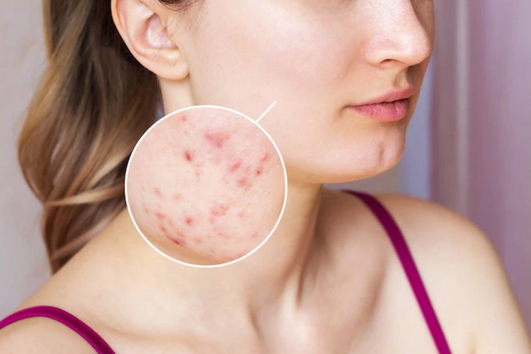 What do you need to know about acne?
