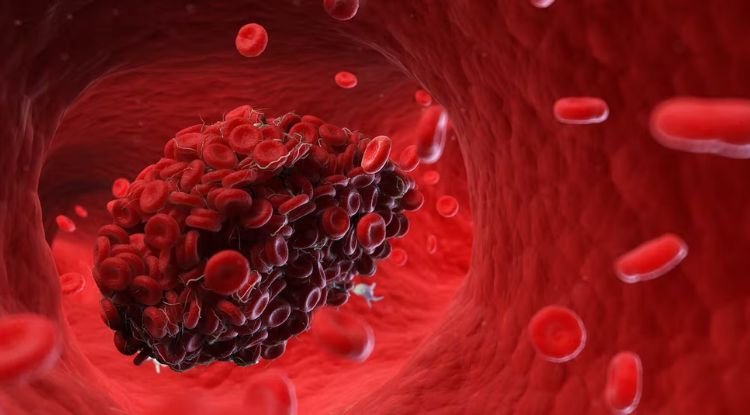 Blood Clots Symptoms