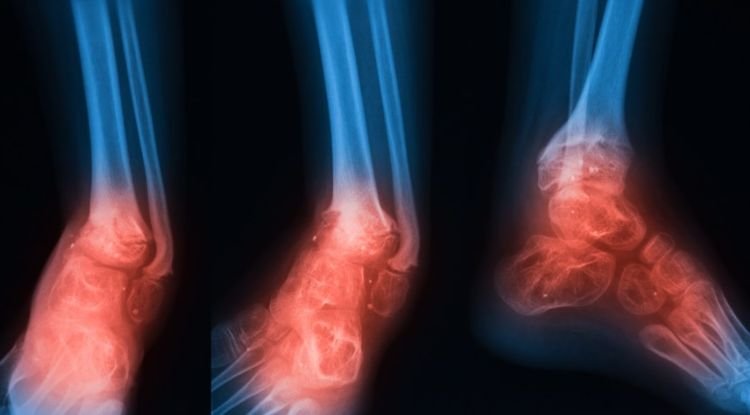 Bone Infection Symptoms