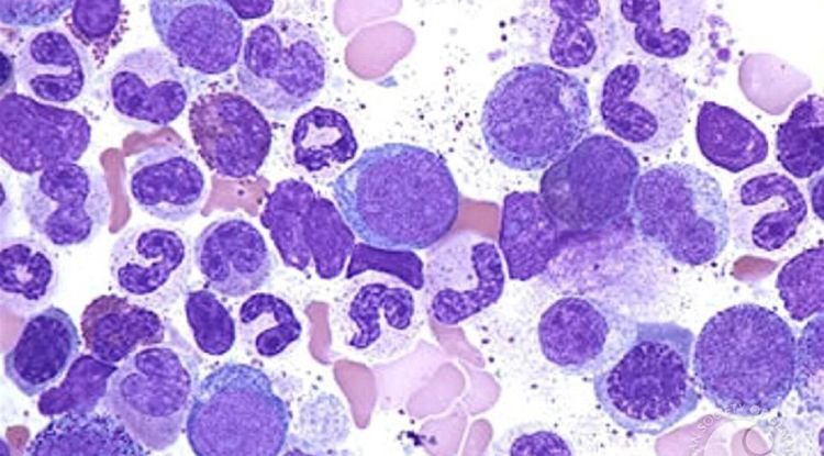 Chronic Myeloid Leukemia Symptoms