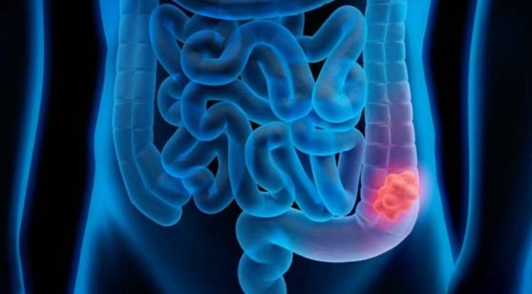 Colon Cancer Symptoms