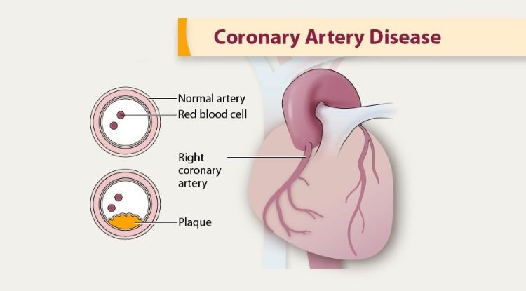 Coronary Artery Disease Symptoms