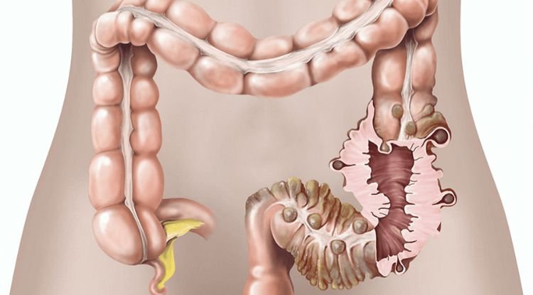 Diverticulosis And Diverticulitis Symptoms