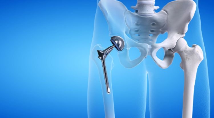 Hip Replacement Symptoms