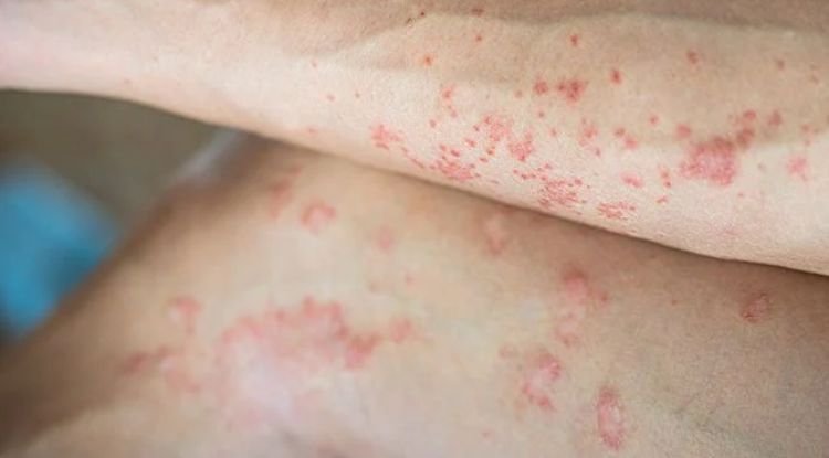 Leukemia Symptoms