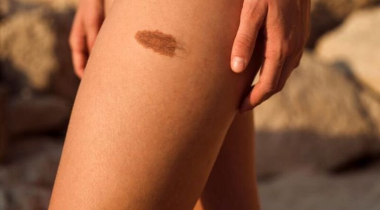 Neurofibromatosis Symptoms