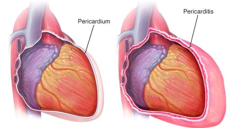 Pericardial Disorders Symptoms