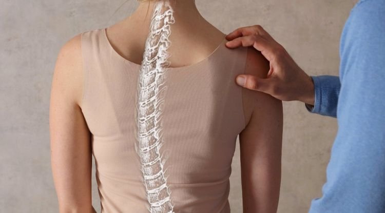 Scoliosis Symptoms