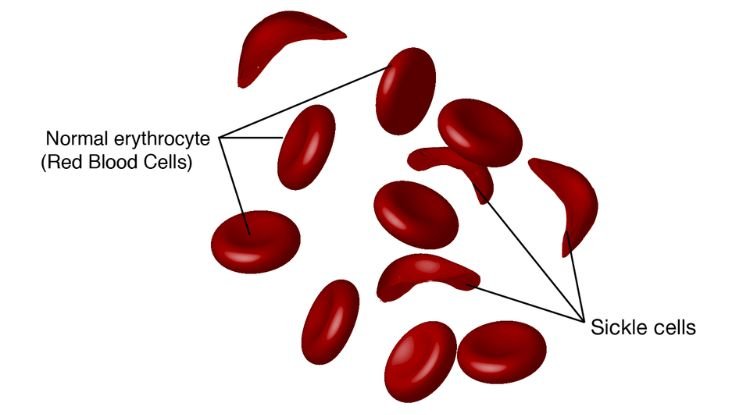 Sickle Cell Anemia Mutation Analysis Symptoms