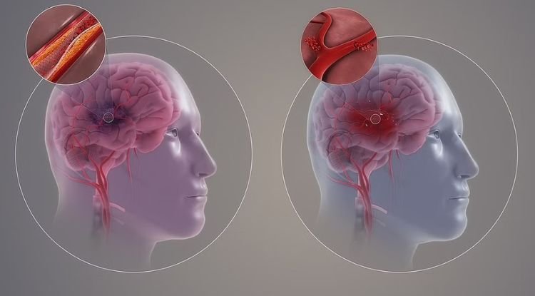 Strokes Symptoms