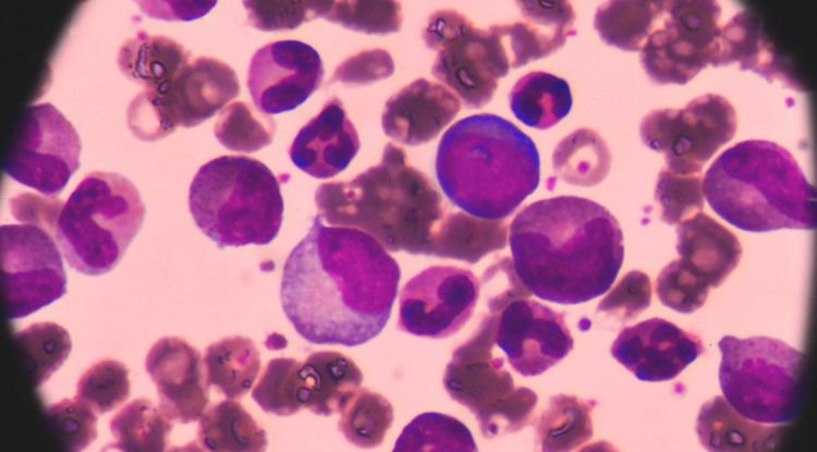 Acute Myeloid Leukemia Symptoms