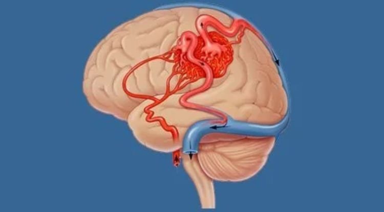 Arteriovenous Malformation Symptoms