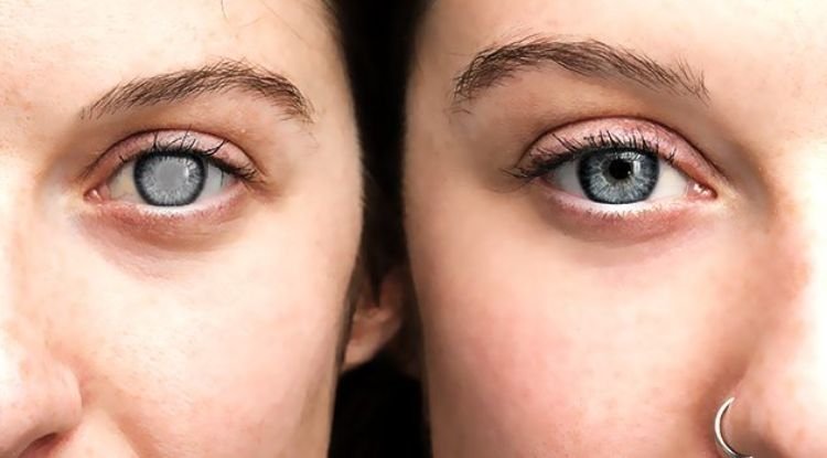 Cataract Symptoms