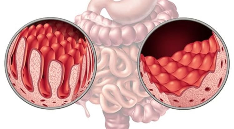 Celiac Disease Symptoms