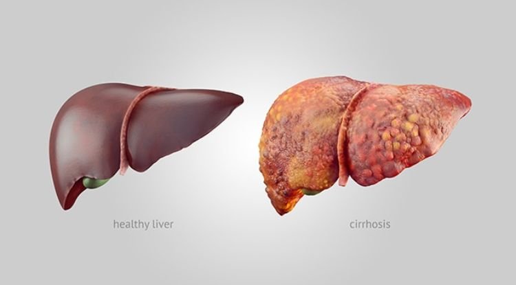 Cirrhosis Symptoms