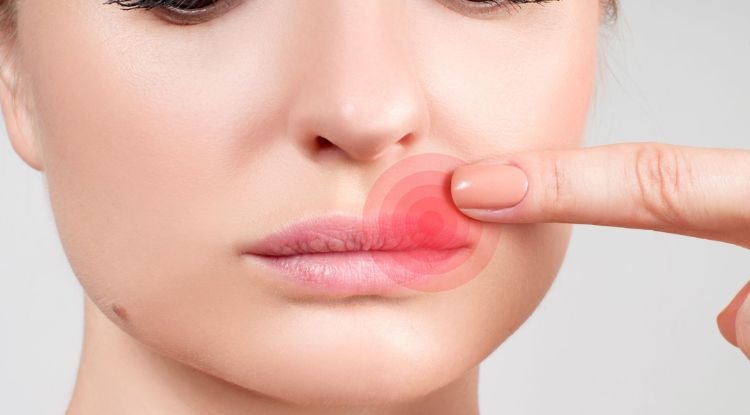 Cold Sores Symptoms