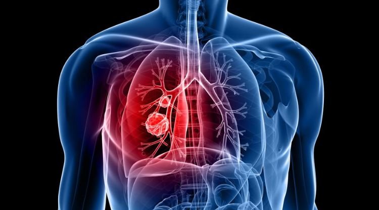 Emphysema Symptoms
