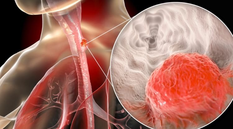 Esophageal Cancer Symptoms