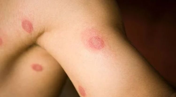 Fungal Infection Symptoms