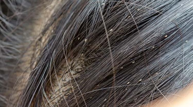 Head Lice Symptoms
