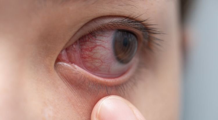 Herpes Symptoms
