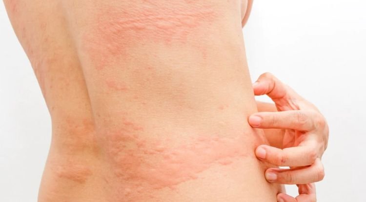 Hives Symptoms