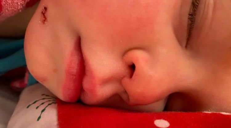 Impetigo Symptoms