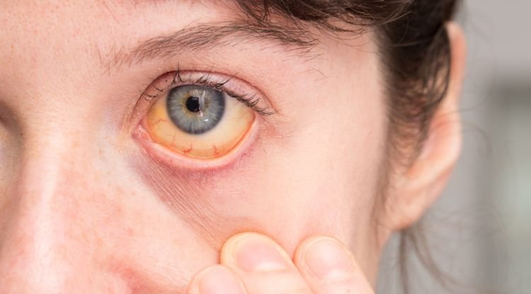 Jaundice Symptoms