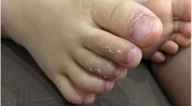 Kawasaki Disease Symptoms