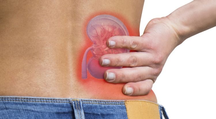 Kidney Stones