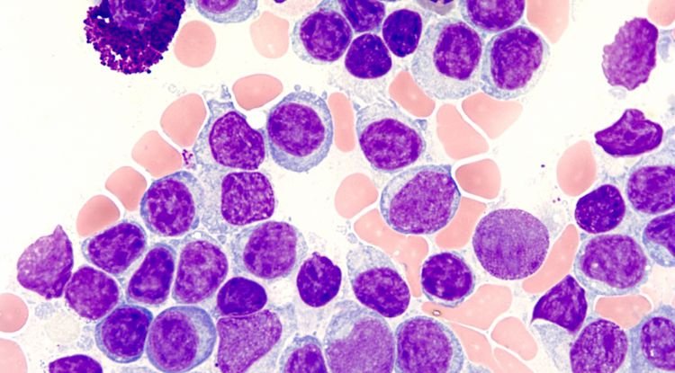 Lymphoplasmacytic Lymphoma Symptoms