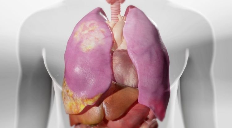 Mesothelioma Symptoms
