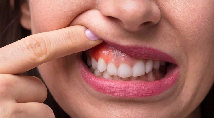 Oral Cancer Symptoms