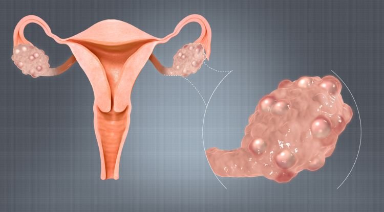 Polycystic Ovary Syndrome Symptoms