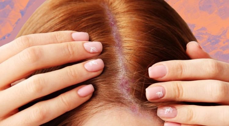 Psoriasis Symptoms