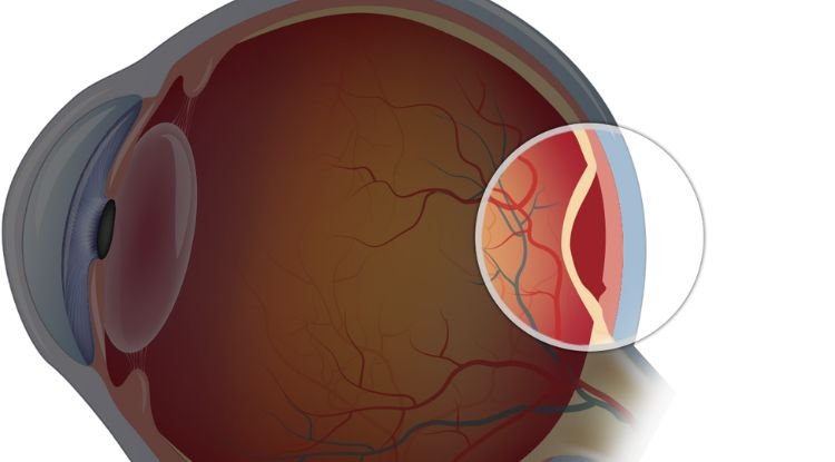 Retinal Detachment Symptoms