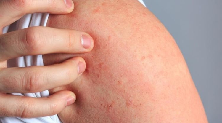 Scabies Symptoms
