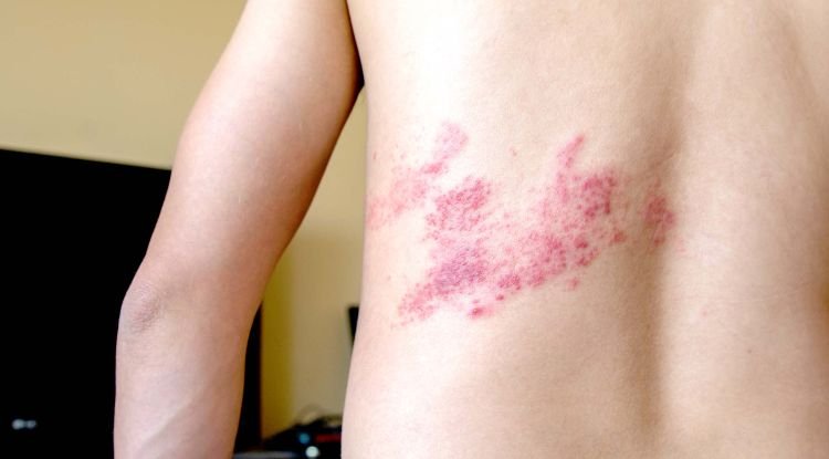 Shingles Symptoms