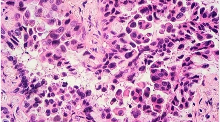 Small Cell Lung Cancer Symptoms