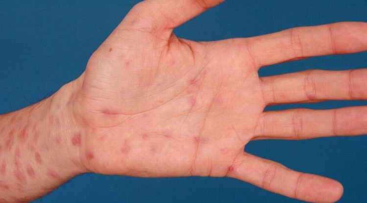 Syphilis Symptoms