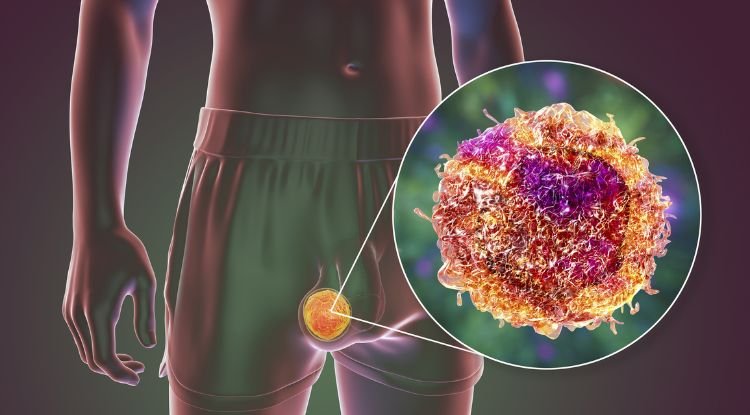 Testicular Cancer Symptoms
