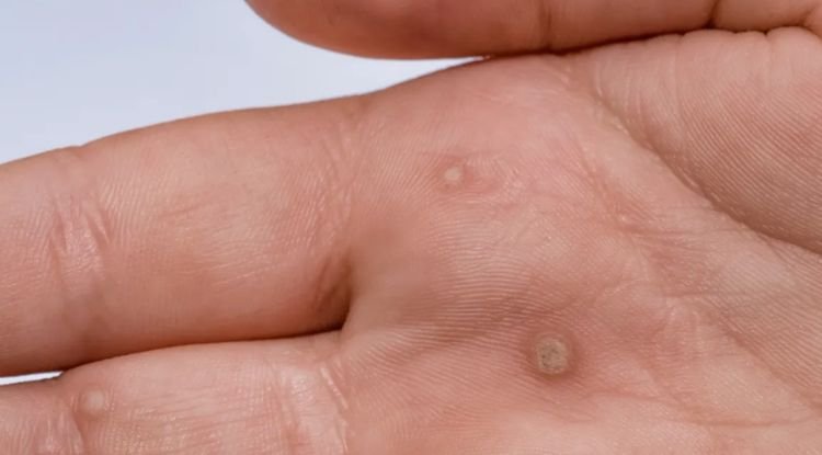 Warts Symptoms
