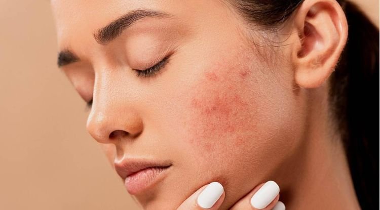 Acne Symptoms