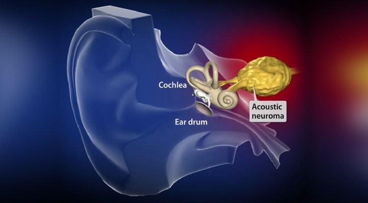Acoustic Neuroma Symptoms