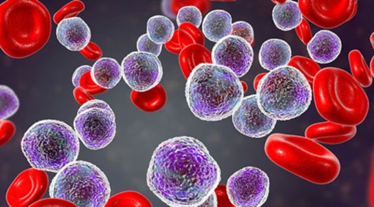Acute Lymphoblastic Leukemia Symptoms